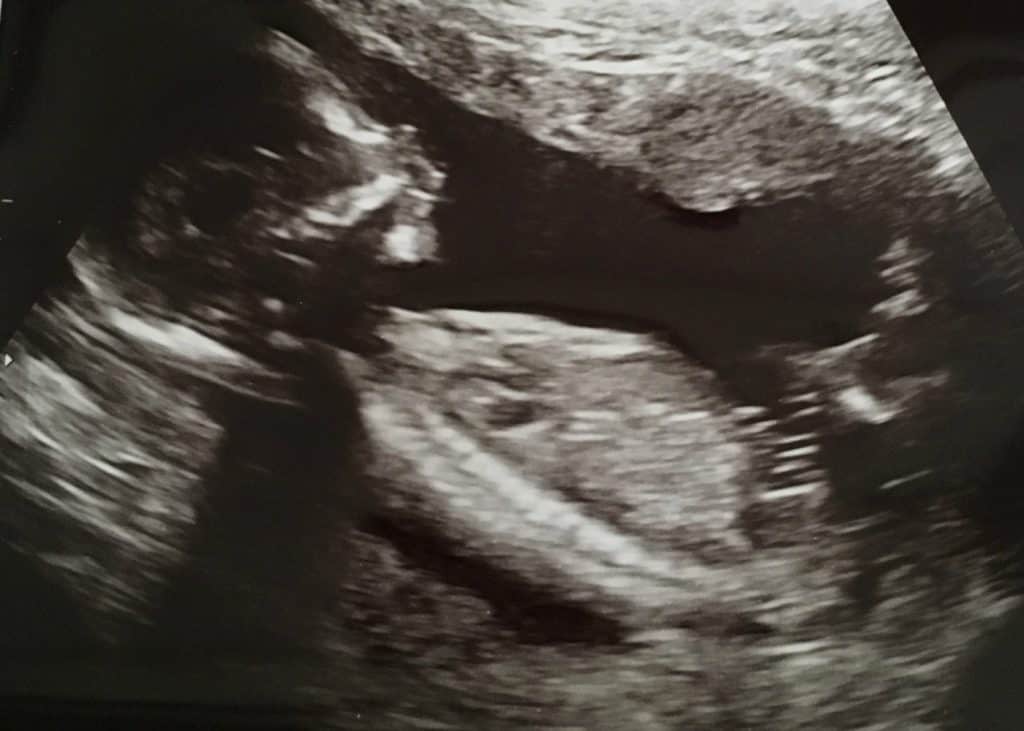 Baby Boy Scan 16w