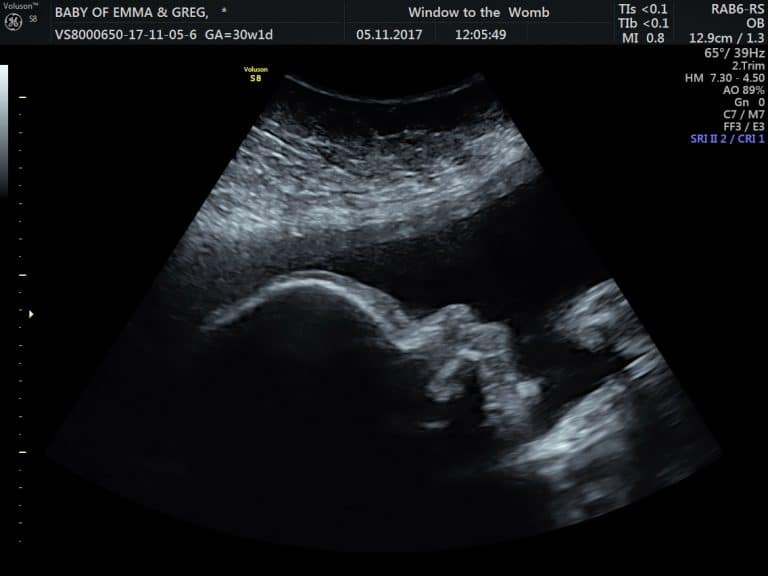 Window to the Womb Baby Boy 2017