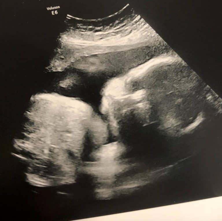 34w+4 pregnant 2017